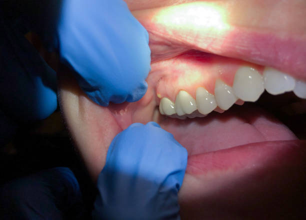 Best Emergency Care for Gum Disease in Jackson, GA